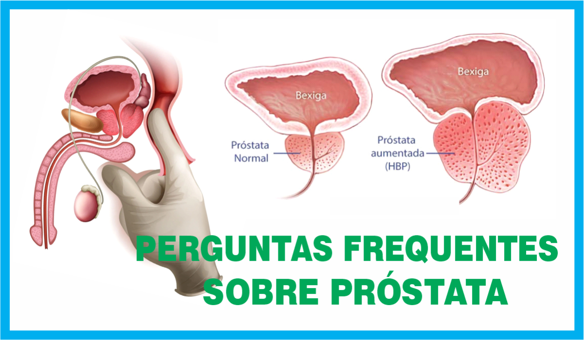 Arte perguntas frequentes sobre próstata 1