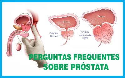 Arte perguntas frequentes sobre próstata 2