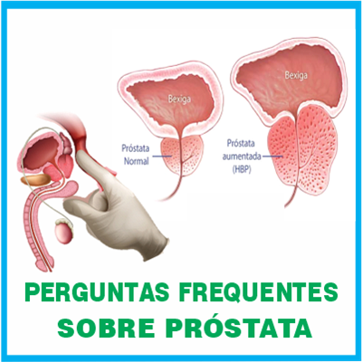 Arte perguntas frequentes sobre próstata 3